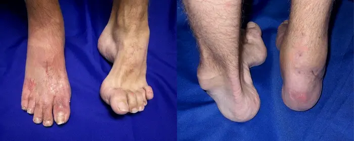 piciorul-charcot-marie-tooth-3