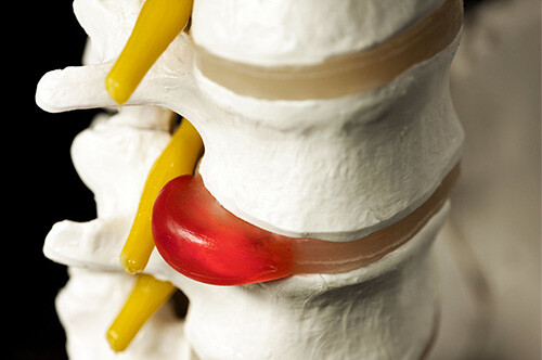 hernia-disc