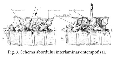 hernia disc 3